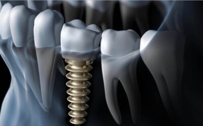 Συχνότερα αίτια αποτυχίας – απώλειας των εμφυτευμάτων