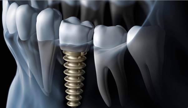 Συχνότερα αίτια αποτυχίας – απώλειας των εμφυτευμάτων