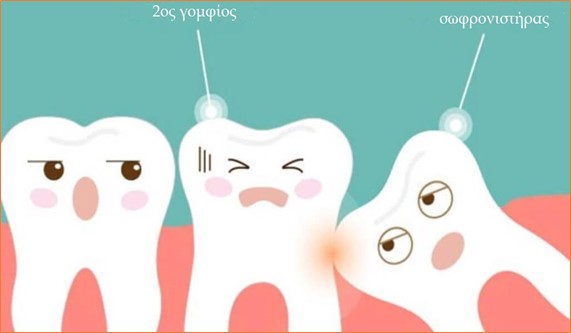 Πόσο διαρκεί η αποθεραπεία μετά τη χειρουργική εξαγωγή σωφρονιστήρων;